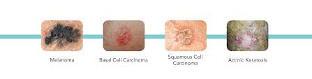 skin cancer diagnosis treatment