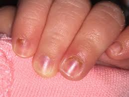 dark spots on es nails babycenter