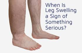 when is leg swelling a sign of