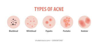 Types Of Acne Images Stock Photos Vectors Shutterstock