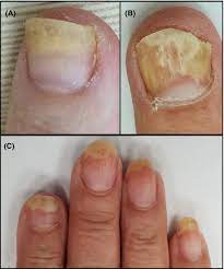 dystrophic fingernails