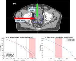 External beam radiotherapy for localized prostate cancer dibiase and others uptodate, 2016. A Typical Radiotherapy Treatment Planning Scan For Prostate Cancer Download Scientific Diagram