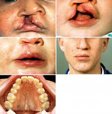 unilateral cleft lip and palate