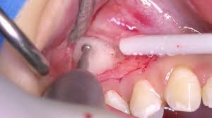 dental surgery small cyst removal by