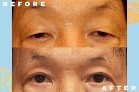 upper eyelid blepharoplasty honolulu