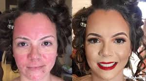 acne scars full coverage makeup