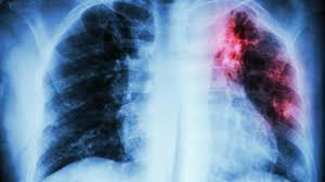 Patrones evolutivos (rx anteriores) correlación con clínica y laboratorio. Salud Fibrosis Pulmonar La Enfermedad Que Se Confunde Con El Asma Y Que Es Peligrosa Para Tu Salud