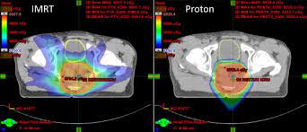 cases for proton beam radiotherapy