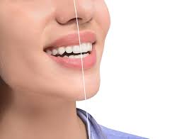 are gum contouring results permanent