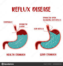 145 Acid reflux diagram Vector Images - Free & Royalty-free Acid reflux  diagram Vectors | Depositphotos®