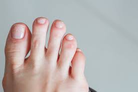 Causes Of White Spots On Your Toenails