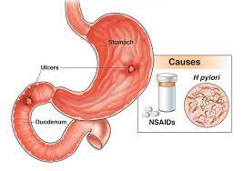 peptic ulcers stomach ulcers