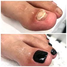 nail reconstruction treatment nails