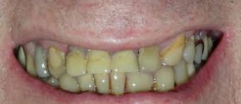Dec 22, 2017 · over time, many common liquids like coffee, tea, and red wine, can cause brown stains on teeth. How Can I Get Rid Of Yellow Teeth Old Town Smiles
