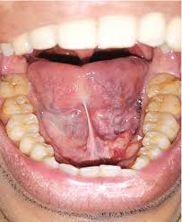 the mouth adenoid cystic carcinoma