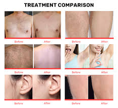most expensive laser hair removal