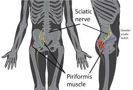 Tens Unit Placement Chart For Sciatica Www