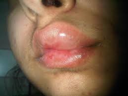 recur lip swelling as a late