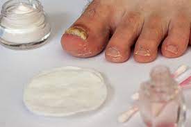 at home relief for toenail fungus