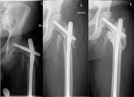 peri implant fracture a rare