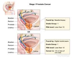 prostate cancer treatment pdq pdq