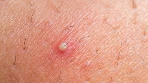 The condition is most prevalent among people who have coarse or curly hair. The One Thing You Should Never Put On An Ingrown Hair Ingrown Hair Treatments Shefinds