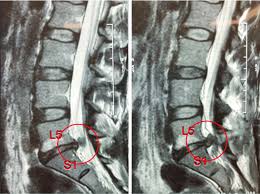 recur disc herniation l5 s1 with
