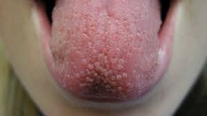 tongue ps potential causes and