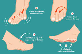 treating athlete s foot a common