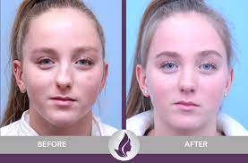 But, what if there's a simpler way that can make the life of someone with a deviated septum a little less uncomfortable. Septoplasty St Paul Nose Surgery Minneapolis