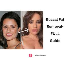 what is buccal fat removal pros cons
