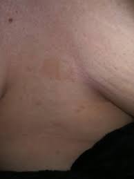 brown spots on chest babycenter