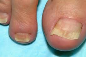 toenail onychomycosis a canadian