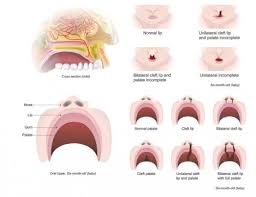 cleft lip and cleft palate dell