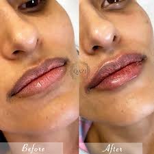 dermal fillers are uneven