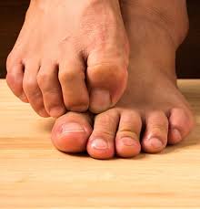 athlete s foot treatment symptoms