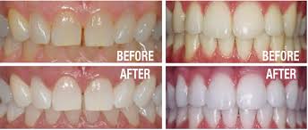 nova dental cosmetic what is teeth