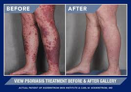 Psoriasis Improve Your Symptoms In Illinois Iowa Soderstrom Skin Institute
