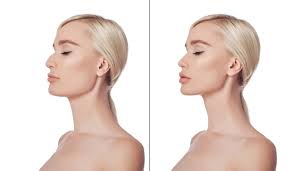 woman cosmetic chin correction