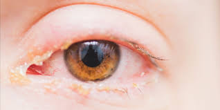 what causes discharge from eyes