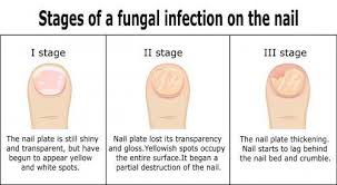 is toenail fungus conious neuhaus
