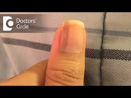 vertical black lines on fingernails