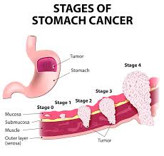 stomach cancer treatment bangalore