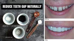 This involves applying a thin layer of tooth coloured resin to the front side of your teeth. How To Fix Gap Teeth Naturally Arxiusarquitectura