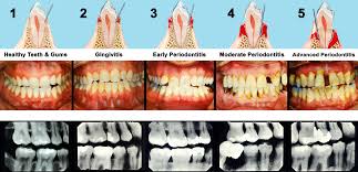 bone loss due to periodontal disease