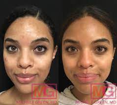 acne scar treatment for dark skin nyc