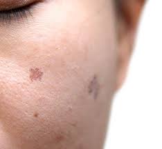 age spots brown spots freckles