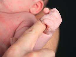 erythema toxi is a common newborn