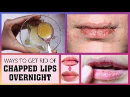 cure dry chapped lips overnight 100