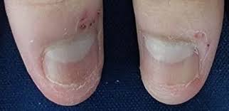 treatment of dystrophic nails